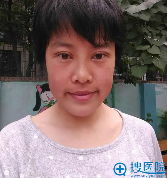 切开双眼皮15天恢复效果图 切开双眼皮15天恢复效果图