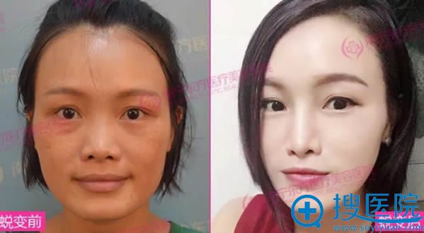 杨礼医生隆鼻案例 杨礼医生隆鼻案例