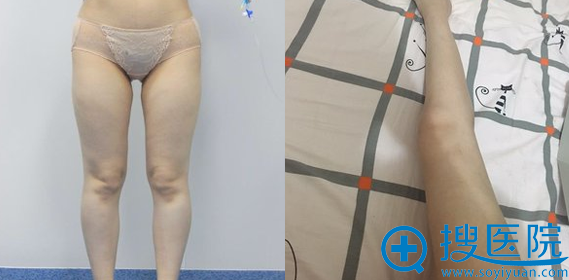 �ɶ������������ҽԺ���������ȳ�֬����
