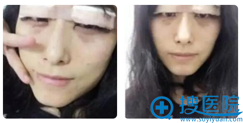 双眼皮术后天 双眼皮术后天