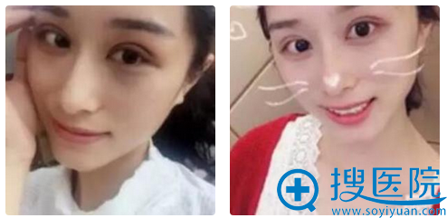 双眼皮术后1个月效果 双眼皮术后1个月效果