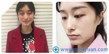厦门海峡谁做双眼皮好?看了张宏医生为我割的双眼皮案例就知道