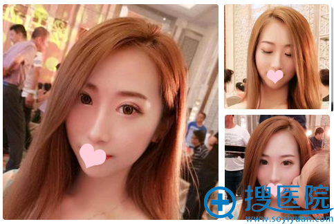 在沈阳名流做完双眼皮一个月自拍 在沈阳名流做完双眼皮一个月自拍