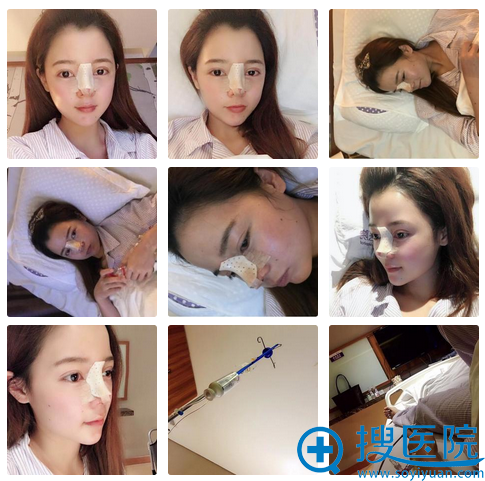 孙明磊医生隆鼻术后天 孙明磊医生隆鼻术后天