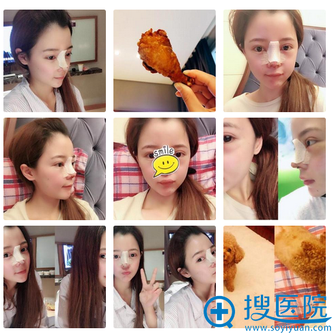 宁波美莱孙明磊隆鼻第二天恢复情况 宁波美莱孙明磊隆鼻第二天恢复情况