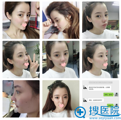 隆鼻7天的我长这样。孙明磊技术太好了 隆鼻7天的我长这样。孙明磊技术太好了