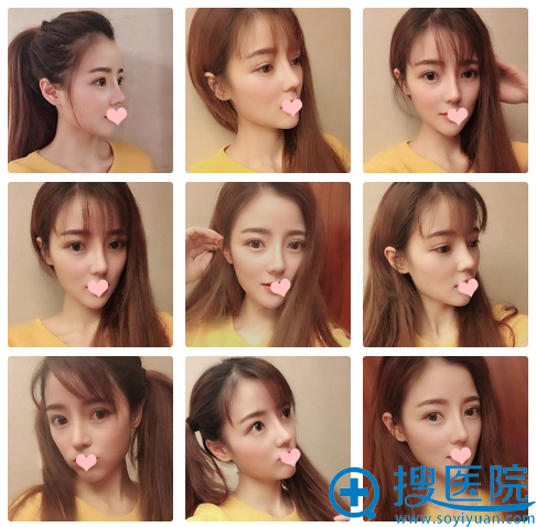 找宁波美莱孙明磊做鼻子一个月自拍 找宁波美莱孙明磊做鼻子一个月自拍