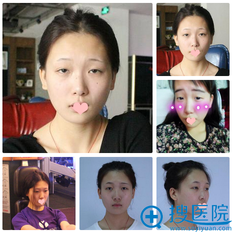 看我找宁波美莱姚远主任割的双眼皮案例效果怎么样