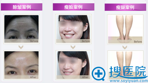 深圳微姿除皱瘦脸瘦腿案例 深圳微姿除皱瘦脸瘦腿案例