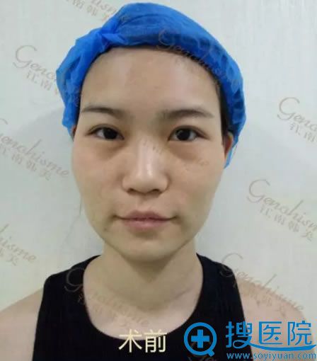 平平做欧式双眼皮前的照片 平平做欧式双眼皮前的照片