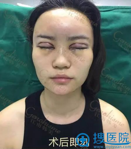 平平做欧式双眼皮手术即刻效果图 平平做欧式双眼皮手术即刻效果图