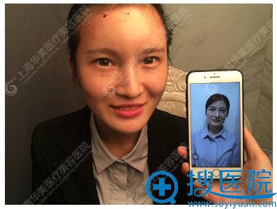 上海华美自体脂肪填充即刻效果 上海华美自体脂肪填充即刻效果