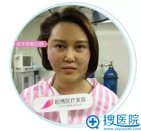 彭医生做完前张脸的效果 彭医生做完前张脸的效果