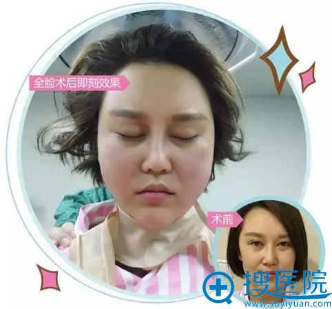 面部填充和线雕术后即刻效果对比 面部填充和线雕术后即刻效果对比