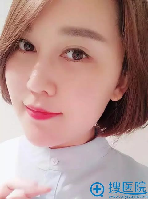成都恒博面部填充和线雕效果 成都恒博面部填充和线雕效果
