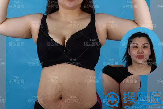 深圳铭医全身吸脂真人案例:四十多的女人的蜕变新生