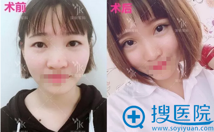 深圳军科刘月更切开双眼皮案例 深圳军科刘月更切开双眼皮案例