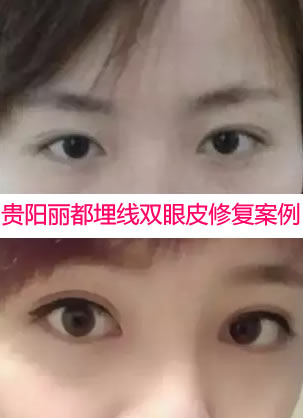 贵阳丽都做埋线双眼皮失败修复效果怎么样 张美女成功修复日记