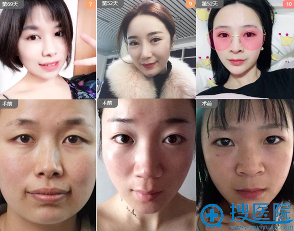 <!--<i data=20240710 data-id=12757></i>-->整形医院双眼皮案例 <!--<i data=20240710 data-id=12757></i>-->整形医院双眼皮案例