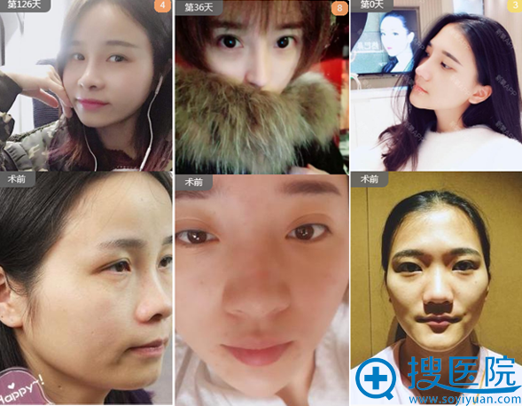 <!--<i data=20240710 data-id=12757></i>-->整形医院隆鼻案例 <!--<i data=20240710 data-id=12757></i>-->整形医院隆鼻案例