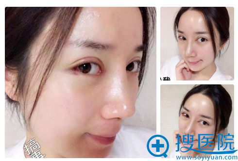 <!--<i data=20240710 data-id=12757></i>-->美杜莎美眼7天拆线情况 <!--<i data=20240710 data-id=12757></i>-->美杜莎美眼7天拆线情况