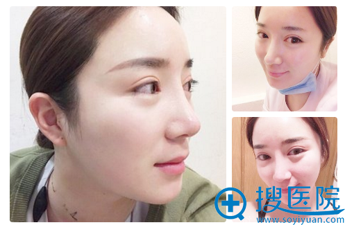 在<!--<i data=20240710 data-id=12757></i>-->做双眼皮和隆鼻2个月效果 在<!--<i data=20240710 data-id=12757></i>-->做双眼皮和隆鼻2个月效果