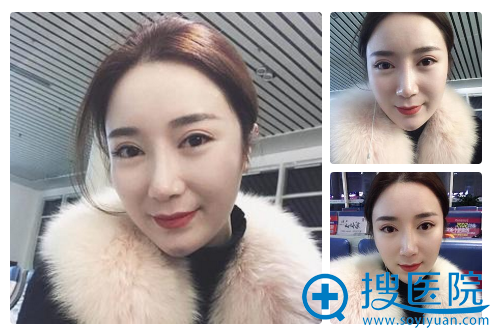上海yestar双眼皮隆鼻术后3个月自拍 上海yestar双眼皮隆鼻术后3个月自拍