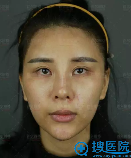 【日记】分享我在上海首尔丽格做全脸自体脂肪填充25天恢复照片