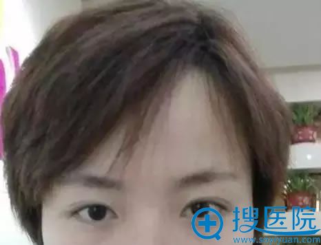 张美女在丽都修复双眼皮前 张美女在丽都修复双眼皮前