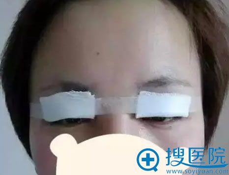 <!--<i data=20240710 data-id=11757></i>-->双眼皮失败修复即刻照片 <!--<i data=20240710 data-id=11757></i>-->双眼皮失败修复即刻照片