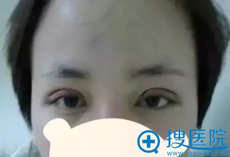 双眼皮失败修复手术第2天 双眼皮失败修复手术第2天