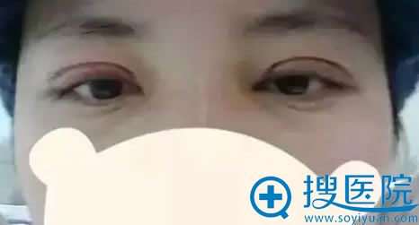 丽都整形双眼皮修复手术第3天 丽都整形双眼皮修复手术第3天