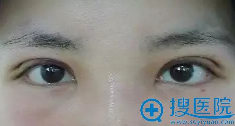 双眼皮修复第4天的效果 双眼皮修复第4天的效果