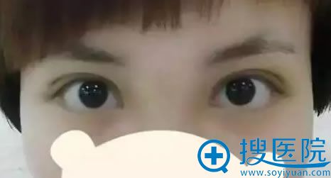 双眼皮修复手术第5天 双眼皮修复手术第5天