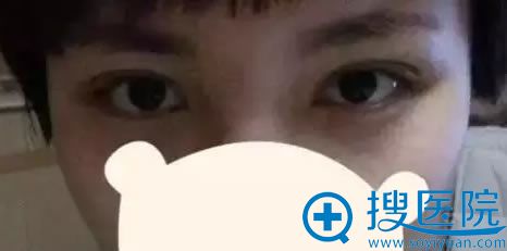 在丽都做双眼皮修复手术第7天 在丽都做双眼皮修复手术第7天
