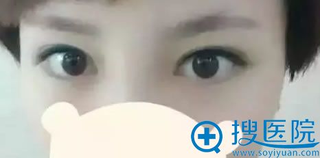 双眼皮修复手术第15天效果 双眼皮修复手术第15天效果