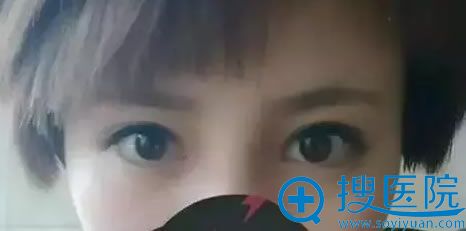 双眼皮修复手术第19天 双眼皮修复手术第19天