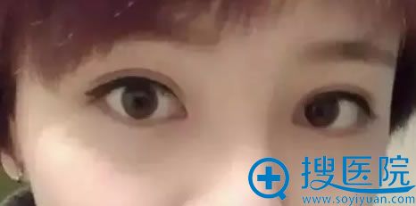 <!--<i data=20240710 data-id=11757></i>-->双眼皮修复效果 <!--<i data=20240710 data-id=11757></i>-->双眼皮修复效果