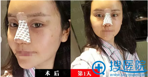 鼻综合+自体脂肪面部填充术后即刻 鼻综合+自体脂肪面部填充术后即刻