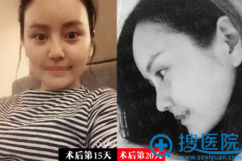 <!--<i data=20240710 data-id=13413></i>-->柏羽鼻综合+自体脂肪面部填充半个月 <!--<i data=20240710 data-id=13413></i>-->柏羽鼻综合+自体脂肪面部填充半个月