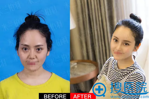 鼻综合+自体脂肪面部填充术前术后对比 鼻综合+自体脂肪面部填充术前术后对比