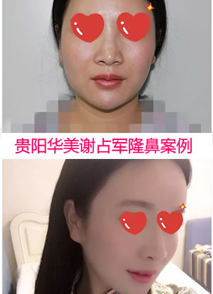 贵阳华美整形医院谢占军隆鼻效果怎么样 线雕隆鼻恢复全过程