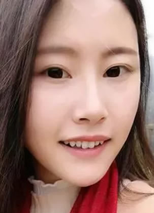天津美莱医院罗金超改脸型效果怎么样 下颌角手术100天成功换脸