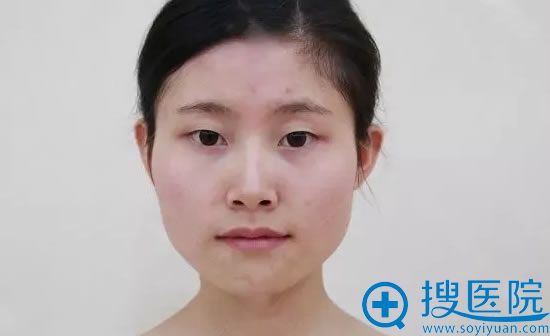 磨骨改脸前的照片 磨骨改脸前的照片