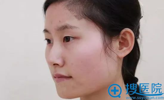 天津美莱下颌角整形前侧面照 天津美莱下颌角整形前侧面照