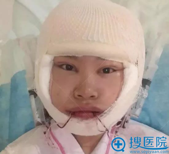 天津美莱下颌角手术第1天 天津美莱下颌角手术第1天