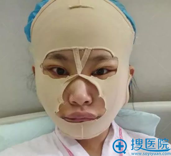 天津美莱改脸型手术第5天 天津美莱改脸型手术第5天