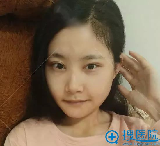 下颌角颧骨整形手术第13天 下颌角颧骨整形手术第13天