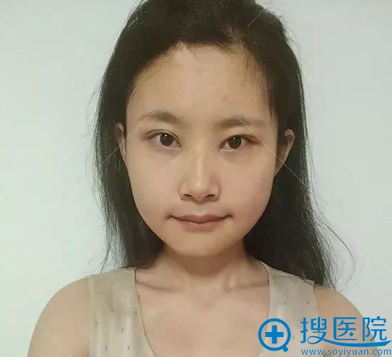 在天津美莱改脸型第30天 在天津美莱改脸型第30天