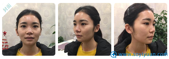 看我在成都华颜整形医院贾德渊医生那里做的鼻子怎么样